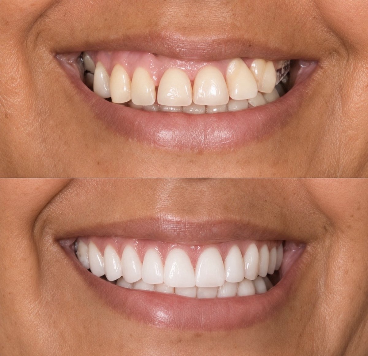 Antes e depois de tratamento estético do sorriso, paciente 1