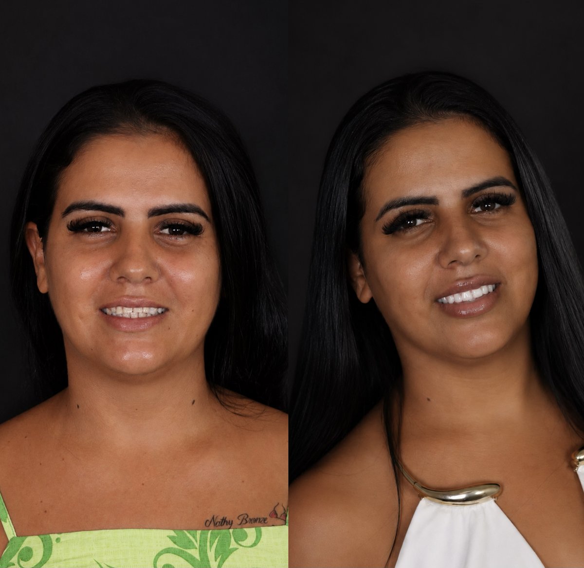 Antes e depois de reabilitação oral, paciente 2
