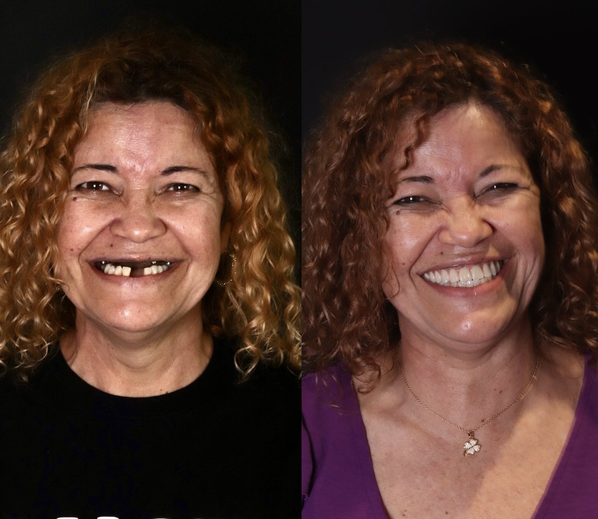 Antes e depois de reabilitação oral, paciente 3