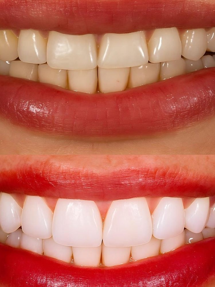Resultado de paciente: Clareamento, antes e depois