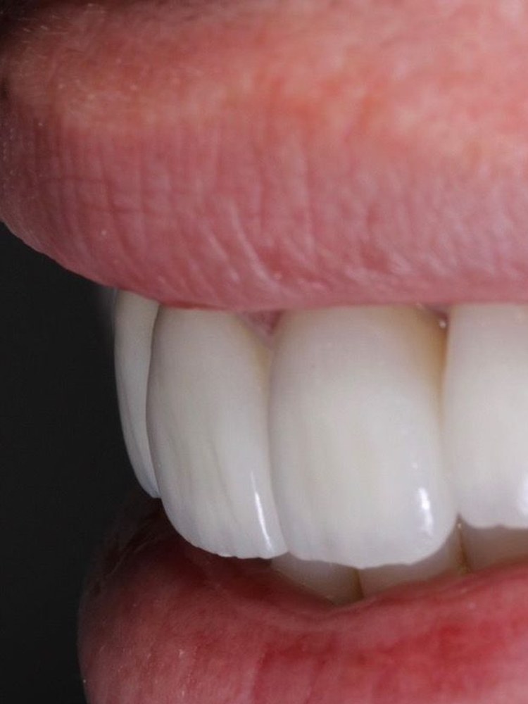 Resultado de paciente: Lente de contato dental